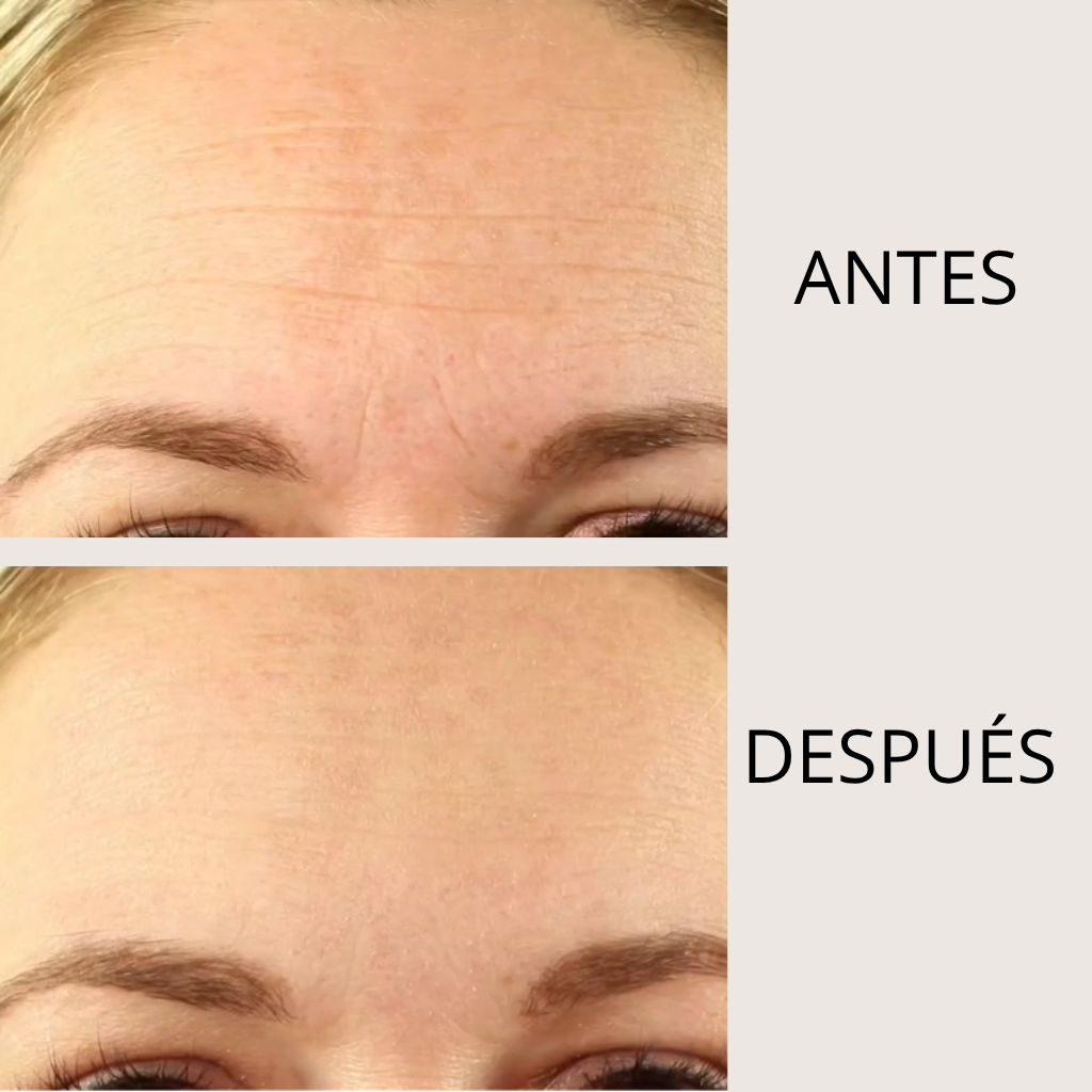 LIFTEA ΑΝΤΙΡΥΤΙΔΙΚΟ ΕΠΙΘΕΜΑ